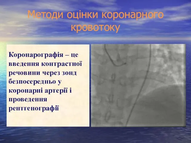 Методи оцінки коронарного кровотоку Коронарографія – це введення контрастної речовини через