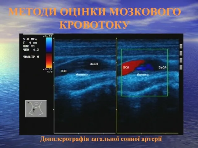 МЕТОДИ ОЦІНКИ МОЗКОВОГО КРОВОТОКУ Допплерографія загальної сонної артерії