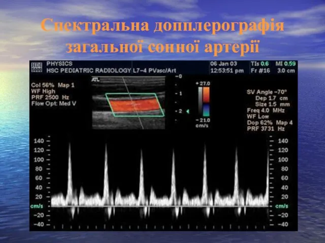 Cпектральна допплерографія загальної сонної артерії