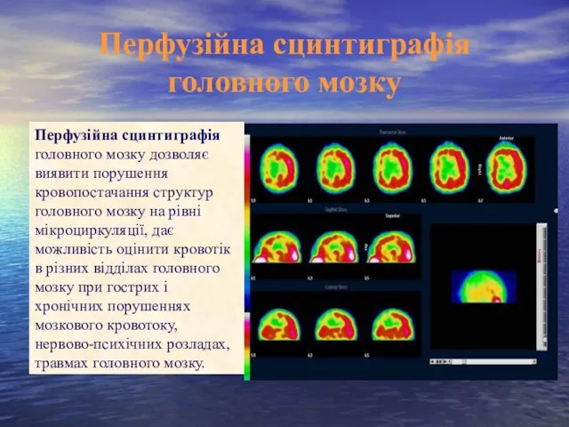 Перфузійна сцинтиграфія головного мозку Перфузійна сцинтиграфія головного мозку дозволяє виявити порушення