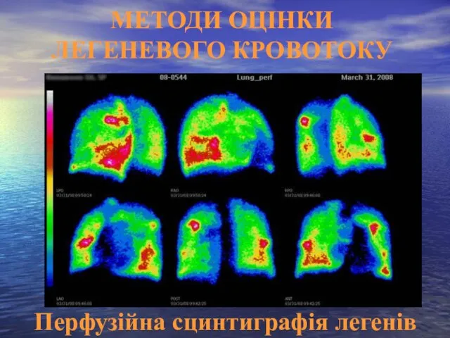 Перфузійна сцинтиграфія легенів МЕТОДИ ОЦІНКИ ЛЕГЕНЕВОГО КРОВОТОКУ