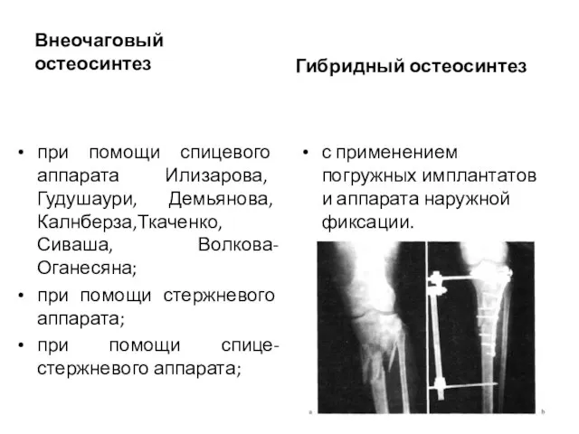 Внеочаговый остеосинтез при помощи спицевого аппарата Илизарова, Гудушаури, Демьянова, Калнберза,Ткаченко,Сиваша, Волкова-Оганесяна;