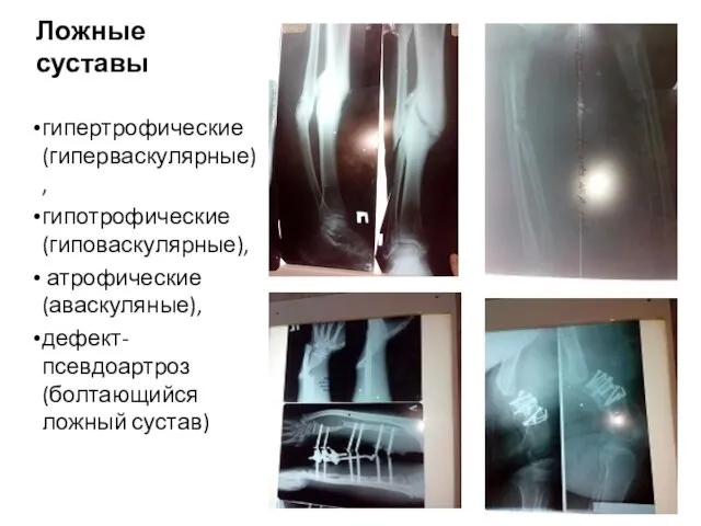 Ложные суставы гипертрофические (гиперваскулярные), гипотрофические (гиповаскулярные), атрофические (аваскуляные), дефект-псевдоартроз (болтающийся ложный сустав)