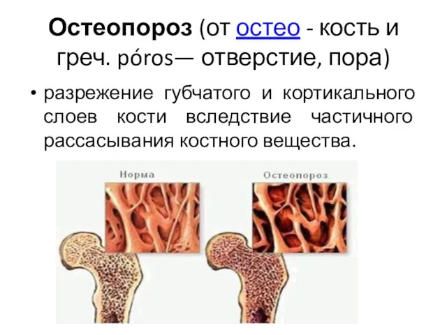 Остеопороз (от остео - кость и греч. póros— отверстие, пора) разрежение