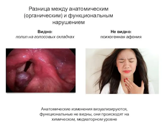 Разница между анатомическим (органическим) и функциональным нарушением Видно: полип на голосовых