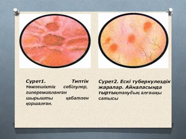 Сурет1. Типтік төмпешіктік себілулер, гиперемияланған шырышты қабатпен қоршалған. Сурет2. Ескі туберкулездік жаралар. Айналасында тыртықтанудың алғашқы сатысы