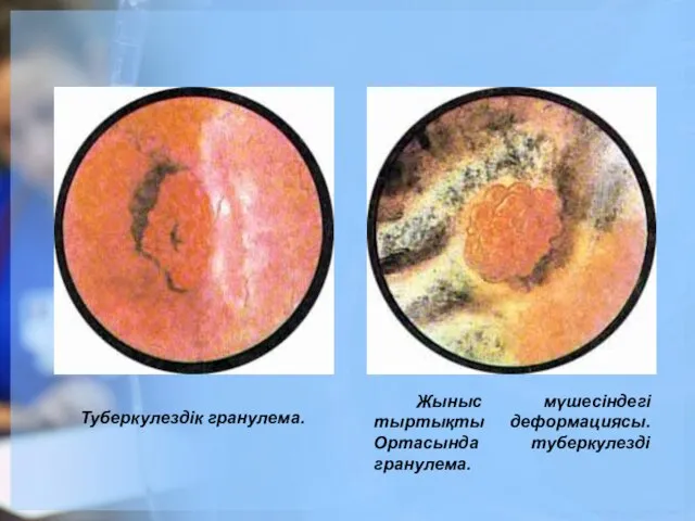 Туберкулездік гранулема. Жыныс мүшесіндегі тыртықты деформациясы. Ортасында туберкулезді гранулема.