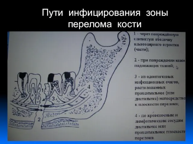 Пути инфицирования зоны перелома кости