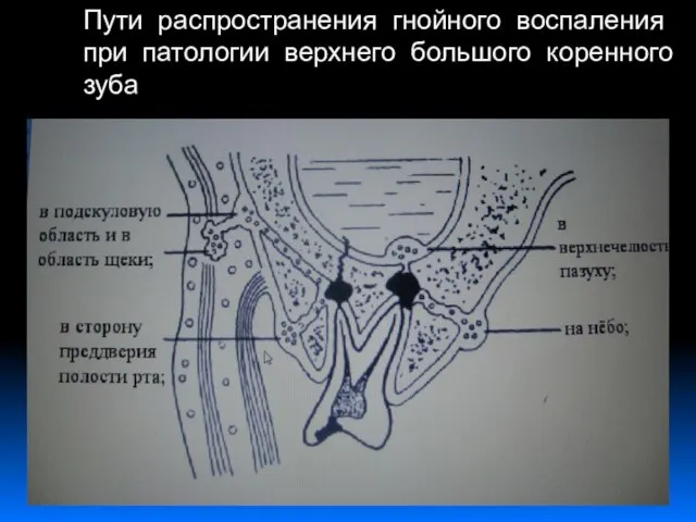 Пути распространения гнойного воспаления при патологии верхнего большого коренного зуба