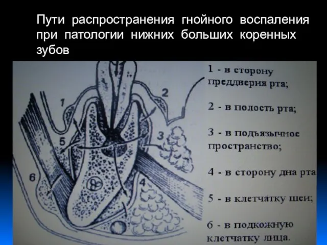 Пути распространения гнойного воспаления при патологии нижних больших коренных зубов