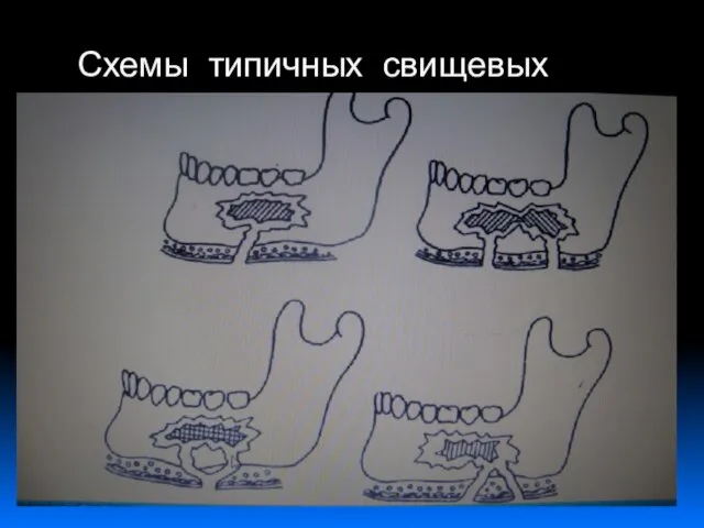 Схемы типичных свищевых ходов