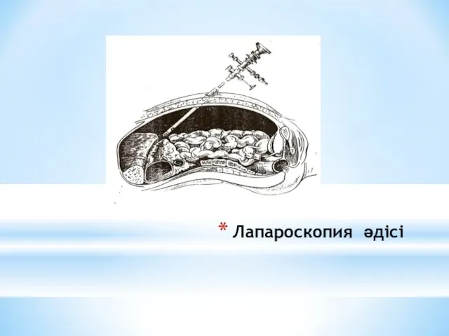 Лапароскопия әдісі