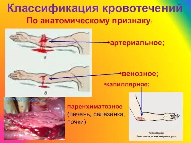 Классификация кровотечений паренхиматозное (печень, селезёнка, почки) По анатомическому признаку: артериальное; венозное; капиллярное;