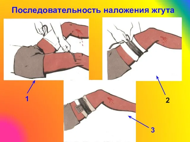 Последовательность наложения жгута 1 2 3