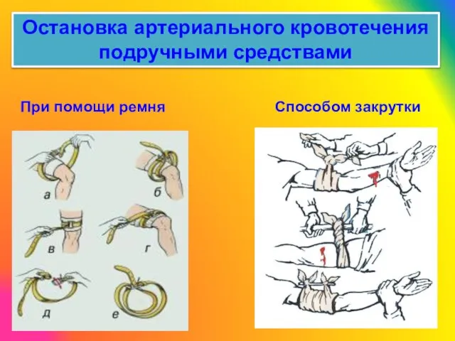 Остановка артериального кровотечения подручными средствами При помощи ремня Способом закрутки