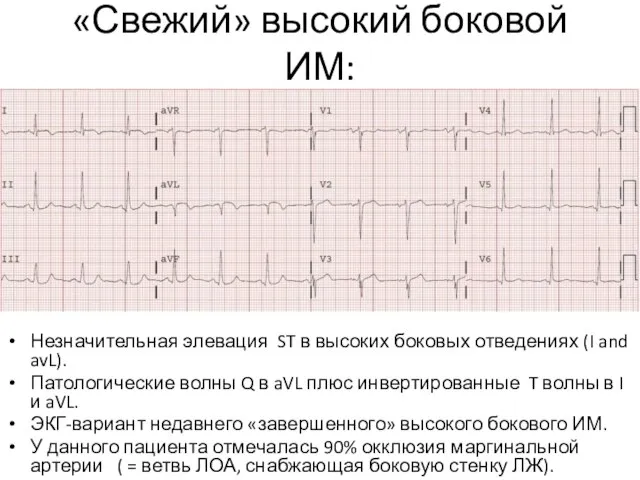 «Свежий» высокий боковой ИМ: Незначительная элевация ST в высоких боковых отведениях