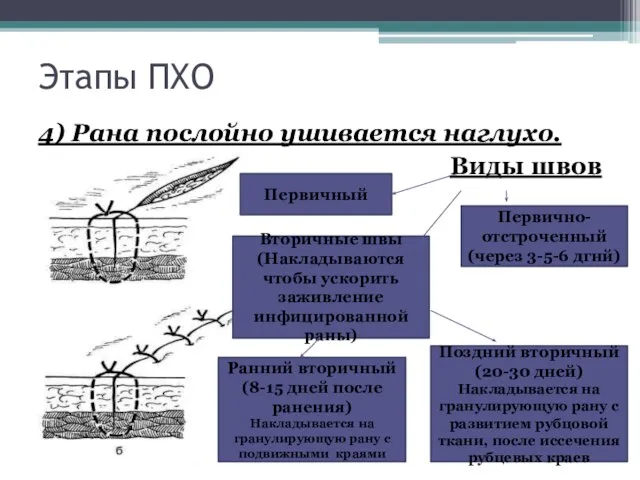 Этапы ПХО 4) Рана послойно ушивается наглухо. Виды швов Первичный Первично-отстроченный