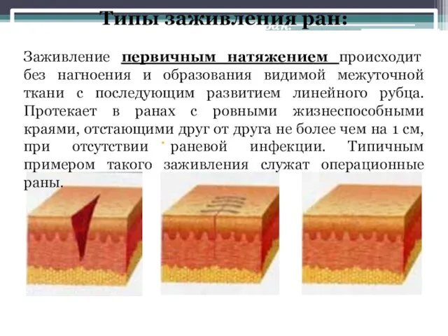 Типы заживления ран: Заживление первичным натяжением происходит без нагноения и образования