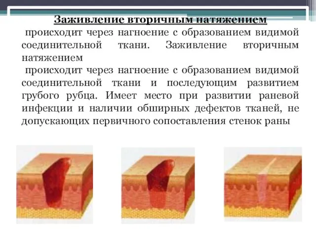 Заживление вторичным натяжением происходит через нагноение с образованием видимой соединительной ткани.