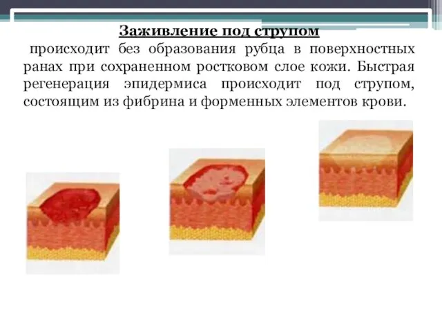 Заживление под струпом происходит без образования рубца в поверхностных ранах при