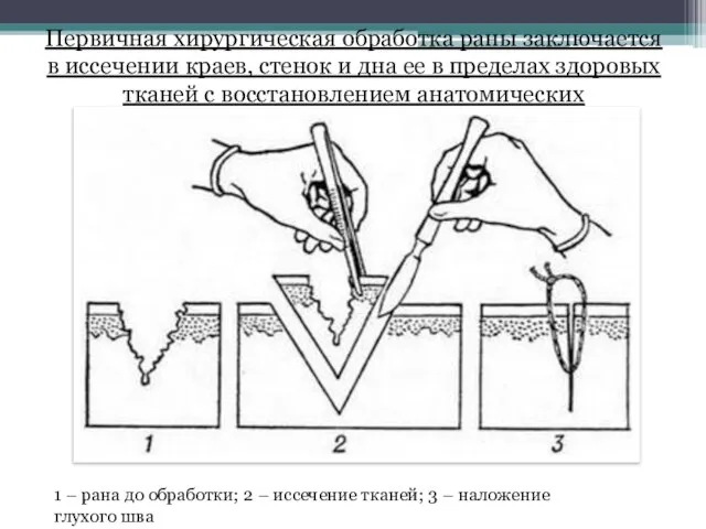 Первичная хирургическая обработка раны заключается в иссечении краев, стенок и дна