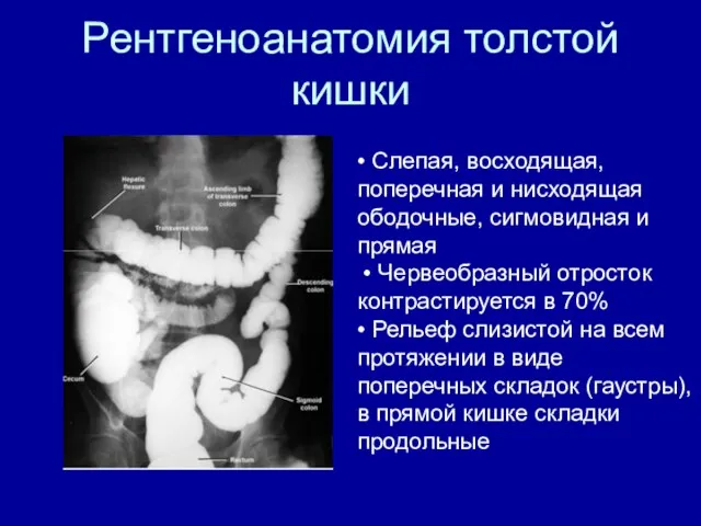 Рентгеноанатомия толстой кишки • Слепая, восходящая, поперечная и нисходящая ободочные, сигмовидная