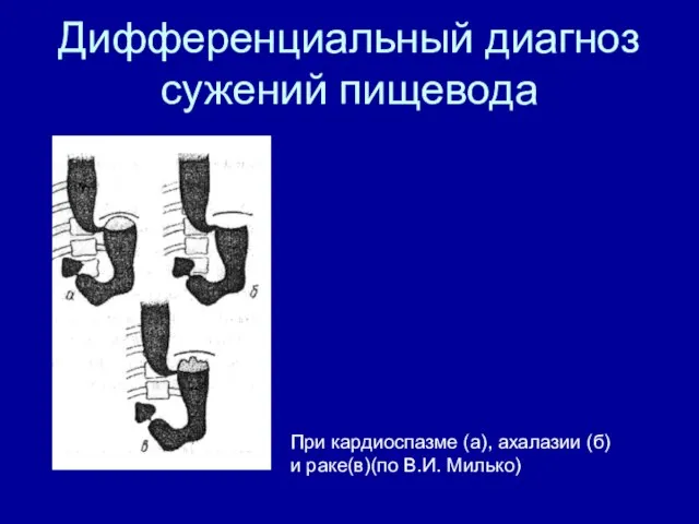 Дифференциальный диагноз сужений пищевода При кардиоспазме (а), ахалазии (б) и раке(в)(по В.И. Милько)