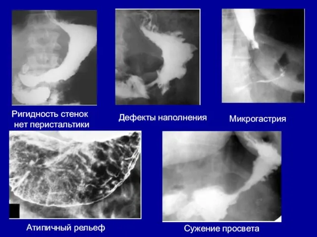 Микрогастрия Дефекты наполнения Ригидность стенок нет перистальтики Атипичный рельеф Сужение просвета