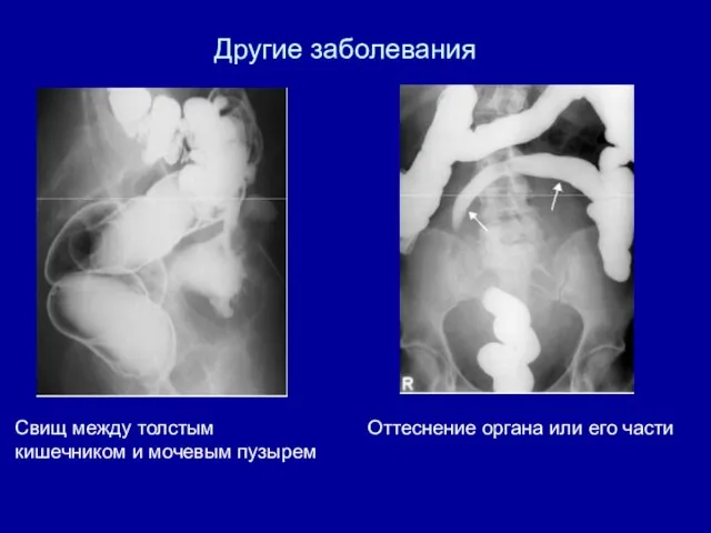 Другие заболевания Свищ между толстым кишечником и мочевым пузырем Оттеснение органа или его части