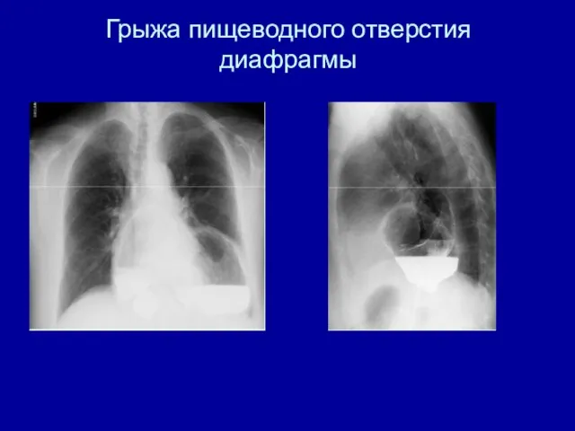 Грыжа пищеводного отверстия диафрагмы