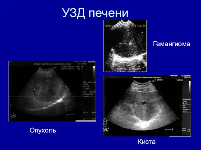 УЗД печени Опухоль Гемангиома Киста