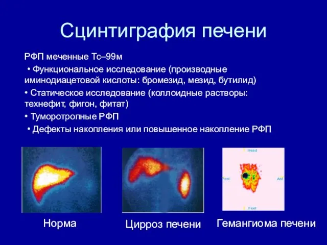 Сцинтиграфия печени РФП меченные Тс‒99м • Функциональное исследование (производные иминодиацетовой кислоты: