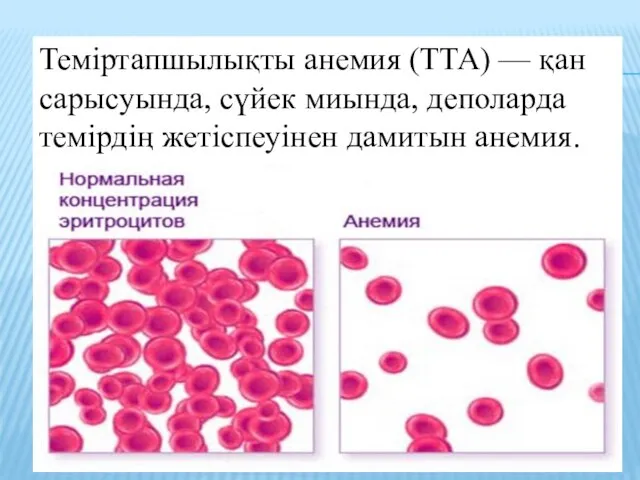 Теміртапшылықты анемия (ТТА) — қан сарысуында, сүйек миында, деполарда темірдің жетіспеуінен дамитын анемия.