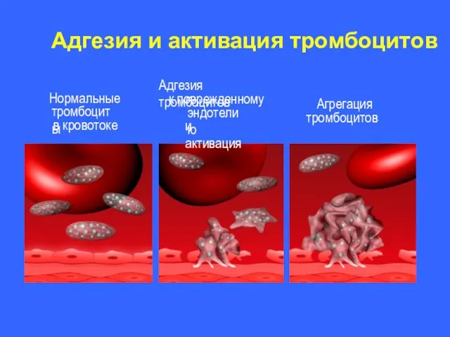 Адгезия и активация тромбоцитов Нормальные тромбоциты в кровотоке Агрегация тромбоцитов Адгезия