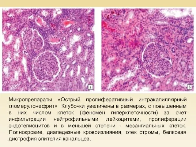 Микропрепараты «Острый пролиферативный интракапиллярный гломерулонефрит» Клубочки увеличены в размерах, с повышенным