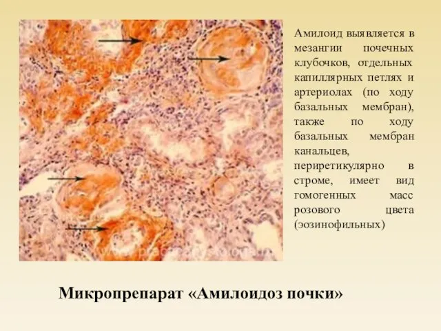 Амилоид выявляется в мезангии почечных клубочков, отдельных капиллярных петлях и артериолах