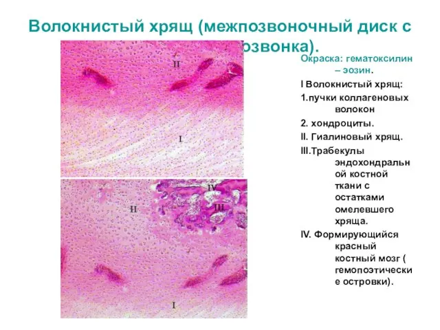 Волокнистый хрящ (межпозвоночный диск с частью тела позвонка). Окраска: гематоксилин –