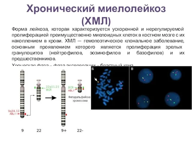 Хронический миелолейкоз (ХМЛ) Форма лейкоза, которая характеризуется ускоренной и нерегулируемой пролиферацией