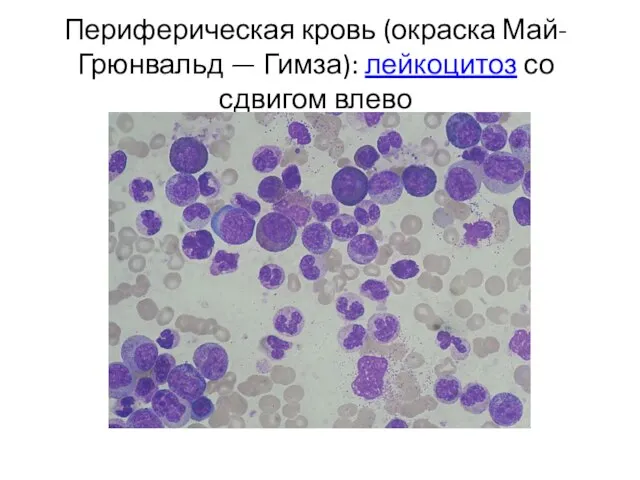 Периферическая кровь (окраска Май-Грюнвальд — Гимза): лейкоцитоз со сдвигом влево