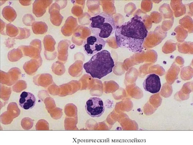 Хронический миелолейкоз