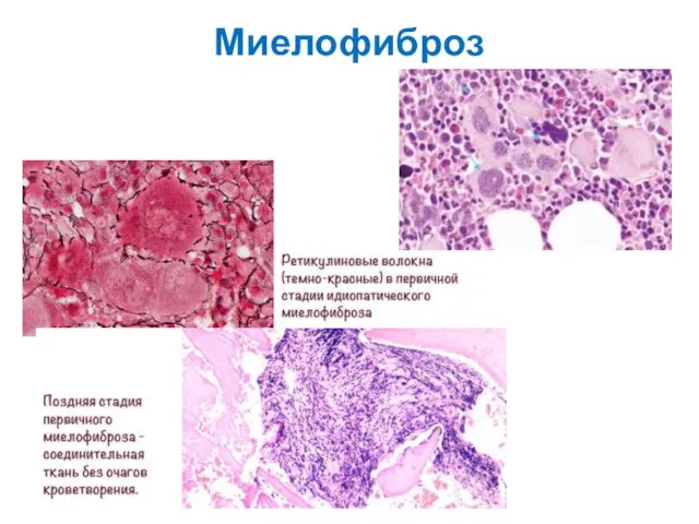 Миелофиброз