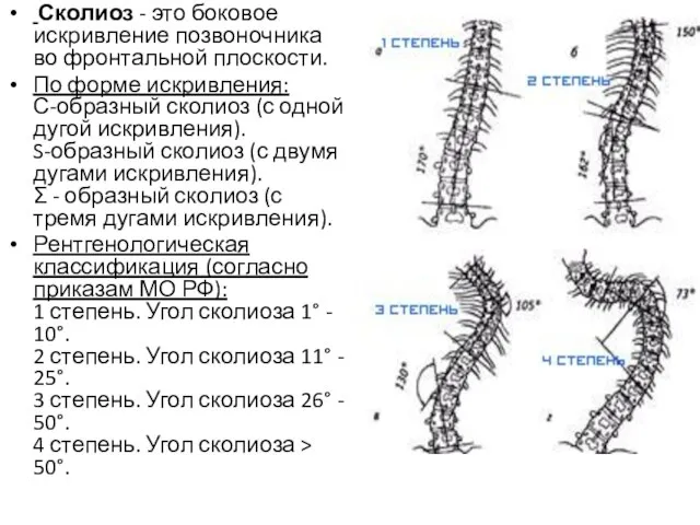 Сколиоз - это боковое искривление позвоночника во фронтальной плоскости. По форме