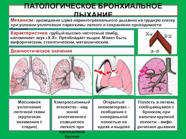 ПАТОЛОГИЧЕСКОЕ БРОНХИАЛЬНОЕ ДЫХАНИЕ Механизм: проведение шума ларинготрахеального дыхания на грудную клетку