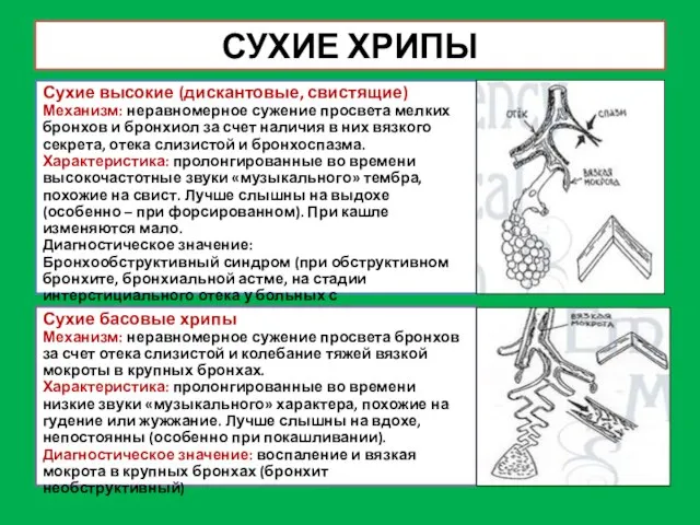 СУХИЕ ХРИПЫ Сухие высокие (дискантовые, свистящие) Механизм: неравномерное сужение просвета мелких