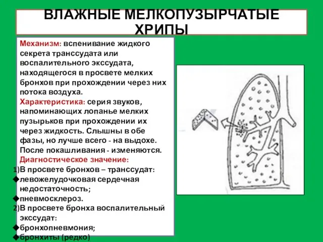 ВЛАЖНЫЕ МЕЛКОПУЗЫРЧАТЫЕ ХРИПЫ Механизм: вспенивание жидкого секрета транссудата или воспалительного экссудата,