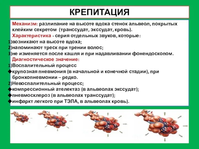 КРЕПИТАЦИЯ Механизм: разлипание на высоте вдоха стенок альвеол, покрытых клейким секретом