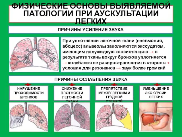 ФИЗИЧЕСКИЕ ОСНОВЫ ВЫЯВЛЯЕМОЙ ПАТОЛОГИИ ПРИ АУСКУЛЬТАЦИИ ЛЕГКИХ При уплотнении легочной ткани