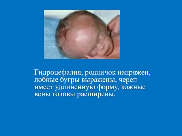 Гидроцефалия, родничок напряжен, лобные бугры выражены, череп имеет удлиненную форму, кожные вены головы расширены.