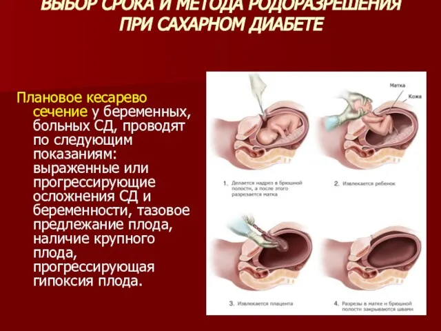 ВЫБОР СРОКА И МЕТОДА РОДОРАЗРЕШЕНИЯ ПРИ САХАРНОМ ДИАБЕТЕ Плановое кесарево сечение