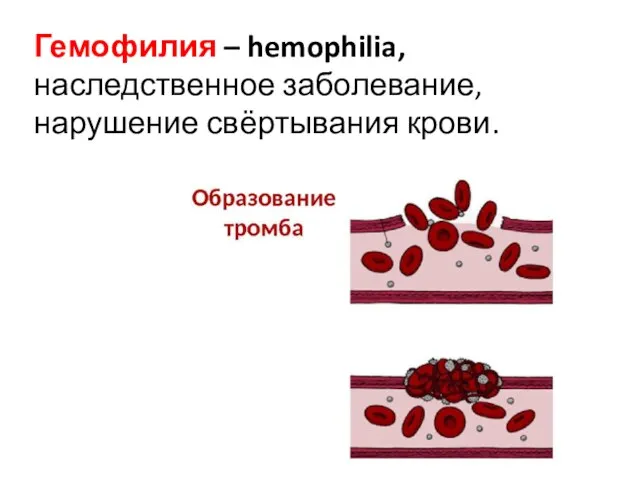 Гемофилия – hemophilia, наследственное заболевание, нарушение свёртывания крови.